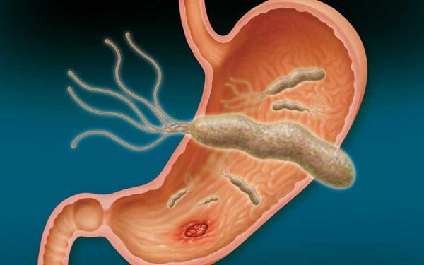 Helicobacter Pylori y Probióticos - Escuela Salud Integrativa